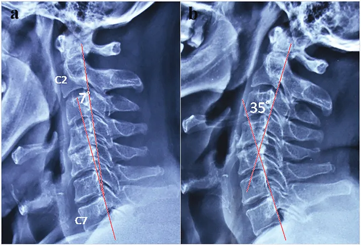 Chiropractic Port Allen LA Corrective Care X-Ray